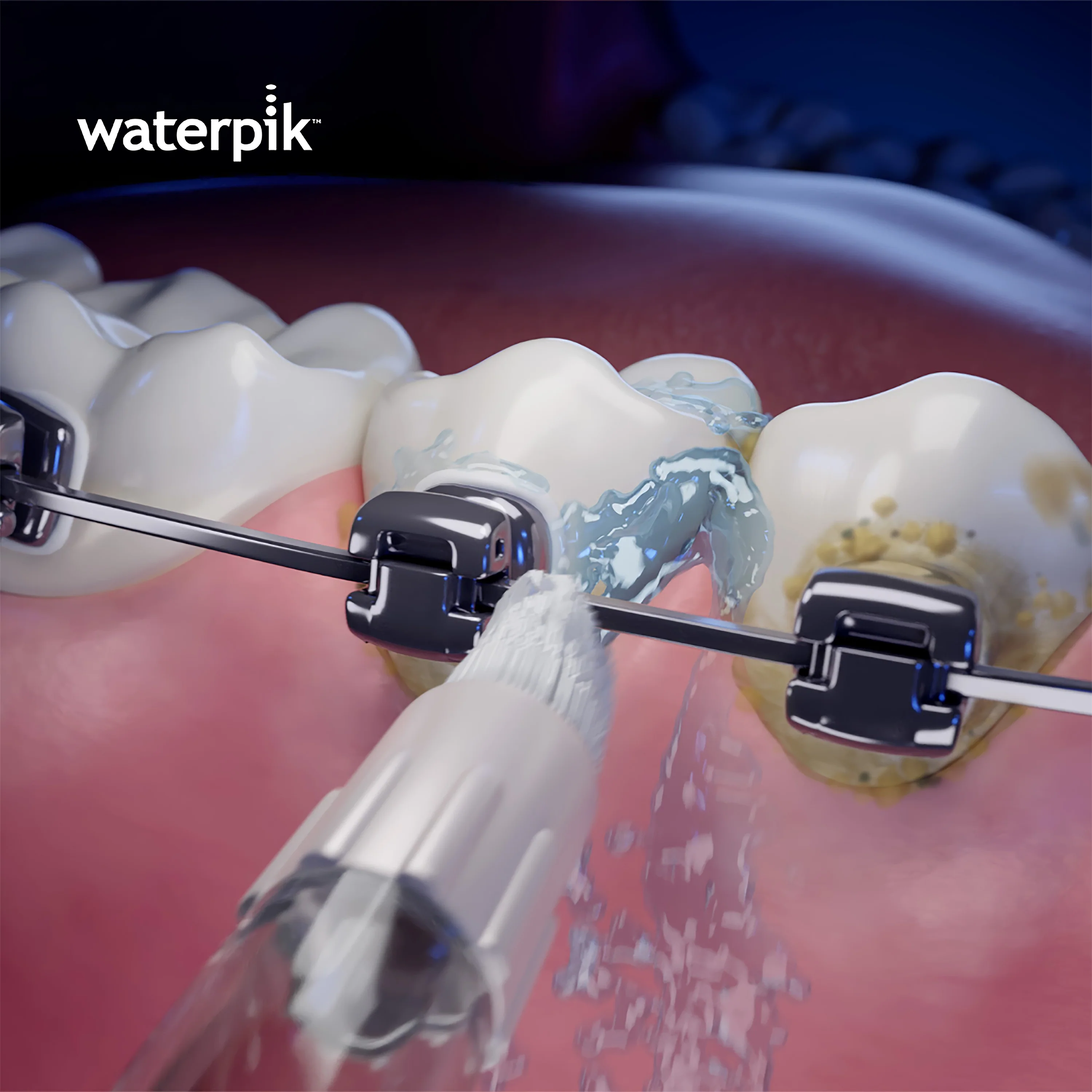 Whitening Orthodontic Tip - Image 3